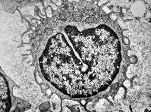 M,33y. | blood - hairy cell leukemia